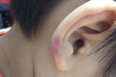 Hà Nội: Cô giáo mầm non đánh con riêng của chồng phải nhập viện