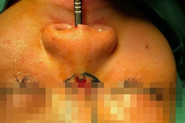 Đi nâng mũi, thiếu nữ bị sụn silicon đâm lòi sống mũi