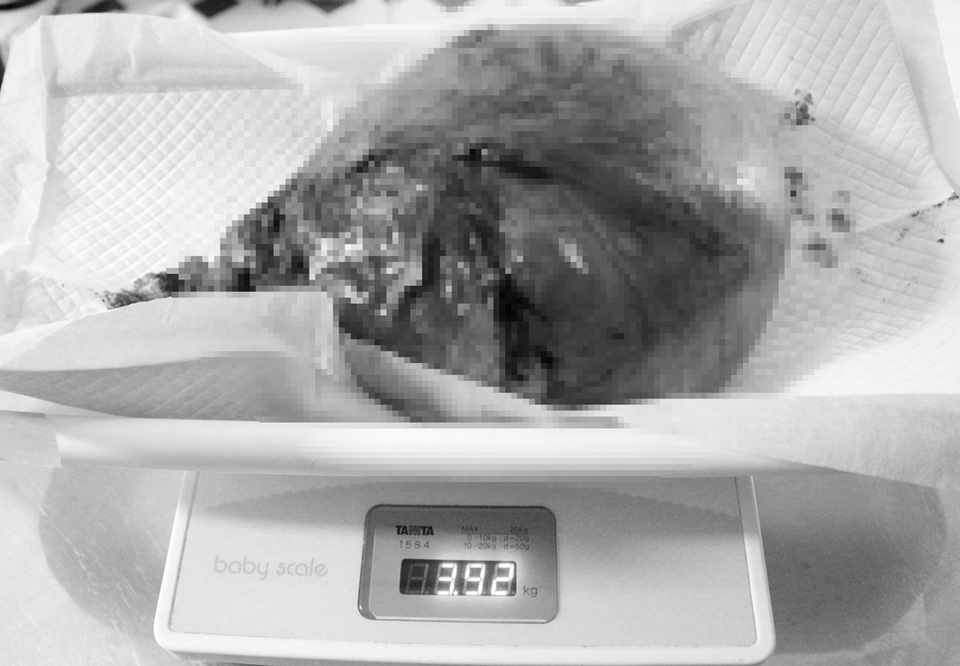 Phẫu thuật thành công cho bệnh nhân bị khối u xơ “khổng lồ” - 1 Phẫu thuật thành công cho bệnh nhân bị khối u xơ “khổng lồ” - 1