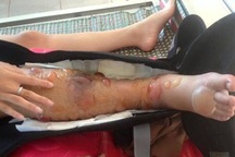 Bác sĩ kém chuyên môn, nữ sinh lớp 10 phải cưa bỏ một chân