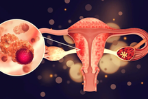 Tuổi nào có nguy cơ mắc ung thư buồng trứng?