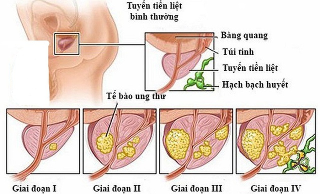 Căn bệnh ung thư cựu Tổng thống Mỹ Joe Biden mắc phải nguy hiểm thế nào? - 2 Căn bệnh ung thư cựu Tổng thống Mỹ Joe Biden mắc phải nguy hiểm thế nào? - 2