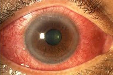 Căn bệnh gây mù loà nhiều người Việt mắc phải nhưng dễ bỏ qua triệu chứng