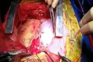 Người đàn ông có 2 quả tim cùng đập