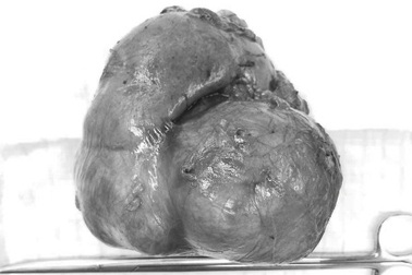 Nữ bệnh nhân mang khối u thận gần 1kg