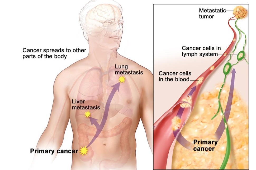 Nổi hạch có phải bị ung thư? - 1