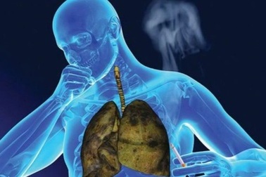 Có nên chụp CT liều thấp định kỳ sàng lọc ung thư phổi?