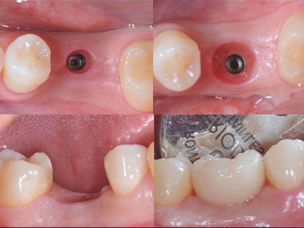Ứng dụng công nghệ DCT trong quy trình trồng răng implant tại Nha khoa Lạc Việt Intech - 3 Ứng dụng công nghệ DCT trong quy trình trồng răng implant tại Nha khoa Lạc Việt Intech - 3