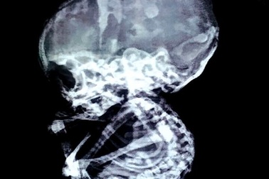 Sốc: Phát hiện bào thai trong bụng sau 15 năm bỏ thai