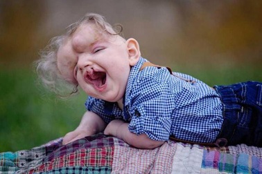 Em bé khuyết sọ đón sinh nhật đầu tiên trong đời