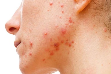 Mụn trứng cá tiết lộ bí mật chỉ ra phương pháp điều trị mới