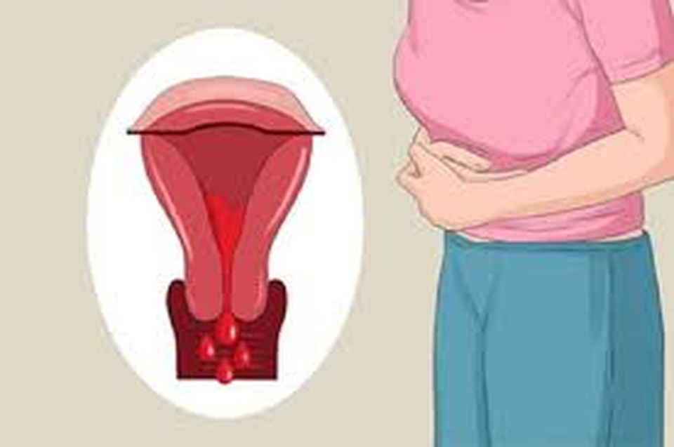 Kinh nguyệt kéo dài – Dấu hiệu u xơ tử cung và giải pháp cải thiện an toàn từ Nga Phụ Khang - 1 Kinh nguyệt kéo dài – Dấu hiệu u xơ tử cung và giải pháp cải thiện an toàn từ Nga Phụ Khang - 1