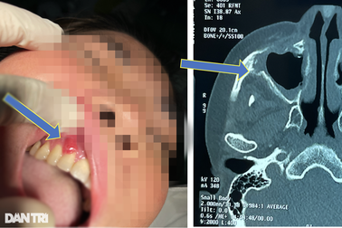Bí ẩn nhiều người phải mổ não, mất mạng vì hoại tử xương sọ "hậu Covid-19"