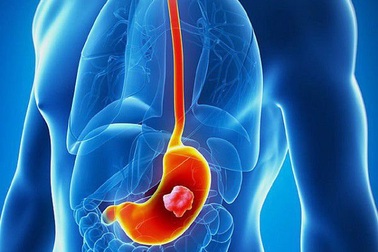 Triệu chứng tiêu chảy trong bệnh ung thư