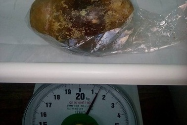 Hy hữu viên sỏi bàng quang nặng 1,5kg