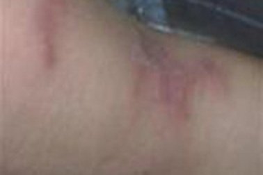 Phòng tái phát viêm da cơ địa