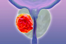 Ung thư và u xơ tuyến tiền liệt khác nhau như thế nào?