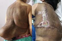 Người phụ nữ ở TPHCM mang "mai rùa" khổng lồ trên lưng vì căn bệnh hiếm