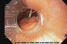 2 chiếc xương cá cùng đâm vào dạ dày