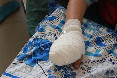 Một phụ nữ bị máy xay thịt nghiền nát bốn ngón tay
