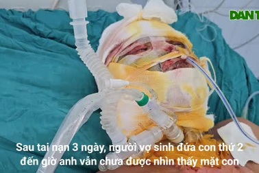 Bỏng điện cao thế, người bố 2 con phải cắt bỏ tay, chân phải