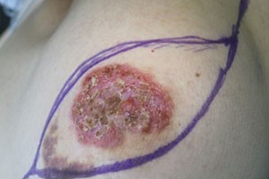 Tưởng nhầm bệnh về da, hóa ung thư vú hiếm gặp