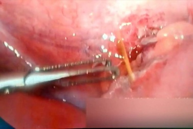 Lấy tăm tre ra khỏi ruột non bệnh nhân