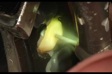 Quá trình chụp phim và thực hiện thủ thuật của robot nha khoa