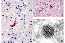 Nguy hiểm vi-rút gây bệnh tay-chân-miệng mới