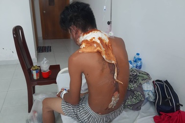 Nam thanh niên nghi bị người thân tạt nước sôi, khiến bỏng nặng phải nhập viện