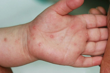Tay chân miệng ở Hà Nội tăng gấp 5 lần cùng kỳ, dự báo tiếp tục "nóng"