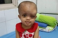 Nhìn bé gái bị ung thư hành hạ hỏng một mắt mà lòng tôi như quặn lại!