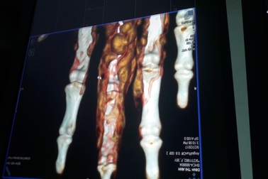 Can thiệp thành công một ca bệnh cảnh hiếm gặp