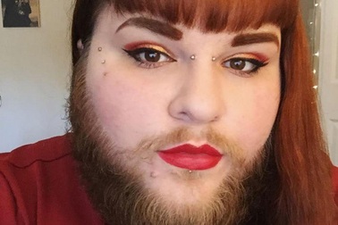 Cô gái có râu quai nón như đàn ông dũng cảm sống thật và đón nhận tình yêu