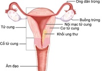 Bệnh nhẹ hóa ung thư chỉ vì không nghe bác sĩ nhập viện điều trị