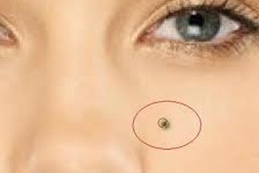 Làm gì khi tẩy nốt ruồi - một đặc điểm nhận dạng trong giấy CMND?