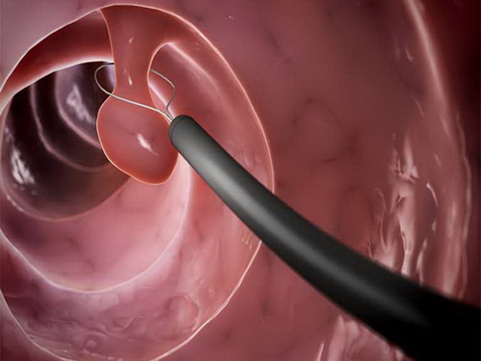 Polyp có dễ thành ung thư? - 1 Polyp có dễ thành ung thư? - 1
