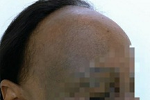 Nữ bệnh nhân bỗng nhiên đen sạm da, nửa đầu rụng hết tóc