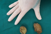 Bé gái 7 tuổi bị tắc ruột vì ăn quá nhiều măng xào, hồng ngâm