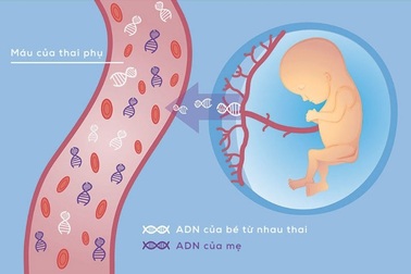 Sàng lọc trước sinh không xâm lấn NIPT - Illumina: Giải pháp an toàn cho mẹ và bé