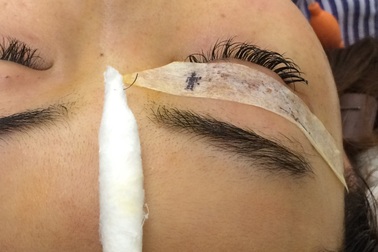 Hoảng hồn cô gái trẻ bị tụt kim trong mắt khi đi nhấn mí