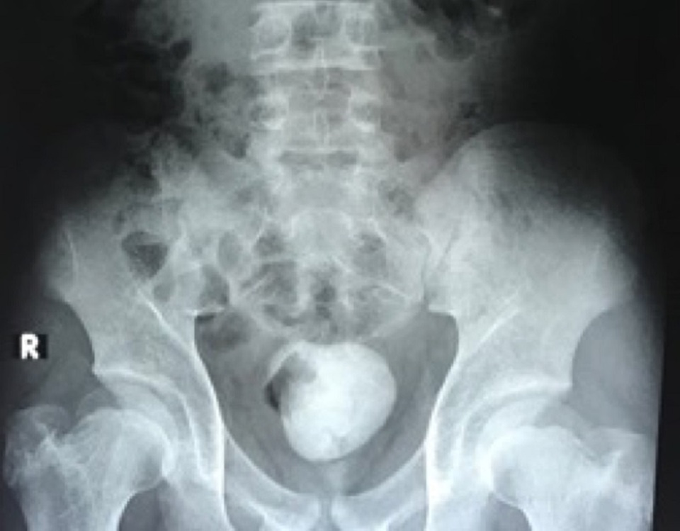 Nam thiếu niên mang cục sỏi khổng lồ ở bàng quang - 1 Nam thiếu niên mang cục sỏi khổng lồ ở bàng quang - 1