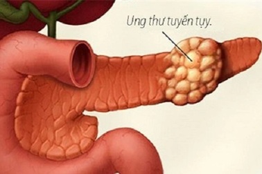Nhiều tiến bộ trong điều trị căn bệnh ung thư ác tính hàng đầu