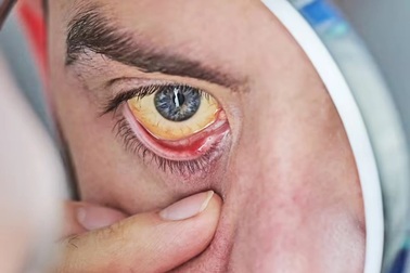 Những dấu hiệu từ làn da báo động gan có vấn đề