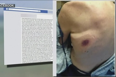 Du khách tử vong vì nhiễm vi khuẩn ăn thịt người sau khi tắm biển