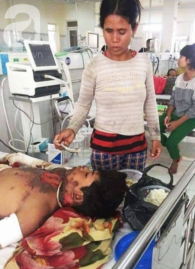 Thương tâm: Vợ chồng nghèo Gia Lai bất lực nhìn bé trai 14 tuổi nguy kịch vì bỏng xăng ngoài rẫy - Ảnh 2. Thương tâm: Vợ chồng nghèo Gia Lai bất lực nhìn bé trai 14 tuổi nguy kịch vì bỏng xăng ngoài rẫy - Ảnh 2.