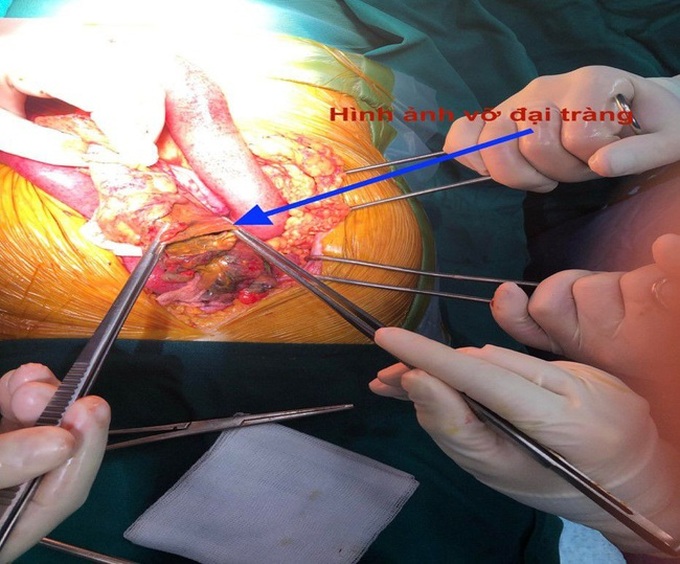 Nhiều người bị đau bụng sau ăn cứ tưởng đau dạ dày mạn tính, ai dè mắc bệnh lý cực nguy hiểm sau! - Ảnh 3. Nhiều người bị đau bụng sau ăn cứ tưởng đau dạ dày mạn tính, ai dè mắc bệnh lý cực nguy hiểm sau! - Ảnh 3.