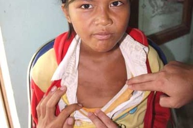 Quảng Ngãi: Bệnh “da dẻ tím tái” không nguy hiểm như bệnh “da lạ”?