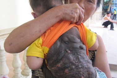 Mong manh sự sống cháu bé 2 tuổi bị u sắc tố da