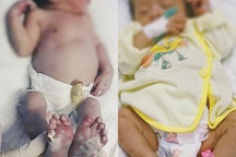 Bé sơ sinh phồng rộp, viêm nhiễm tay chân do lây bệnh giang mai từ mẹ